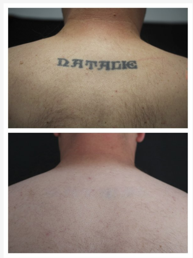 Laser Tattoo Removal - POMMIER