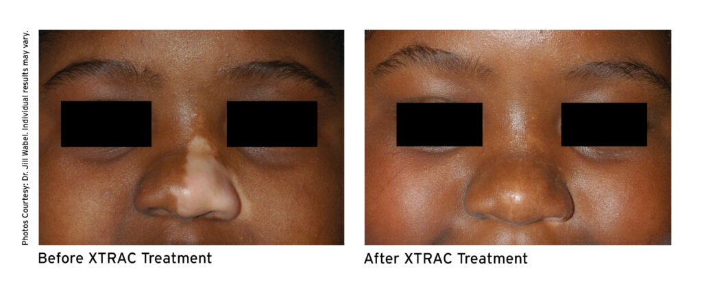 XTRAC VITILIGO TREATMENT BEFORE AND AFTER